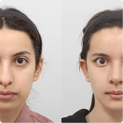 Facelift Before After — Dr. Prateek Gupta Jaipur