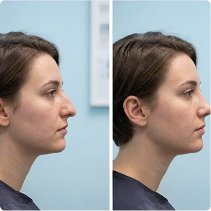 Rhinoplasty Before After — Dr. Prateek Gupta Jaipur